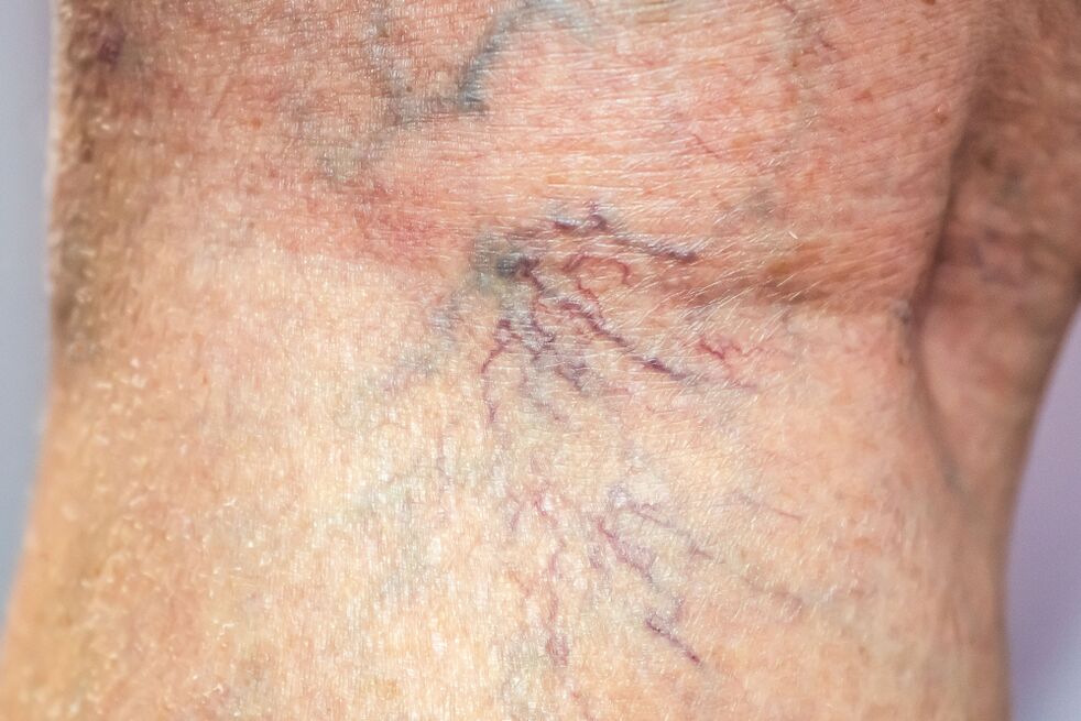 varices sur le corps