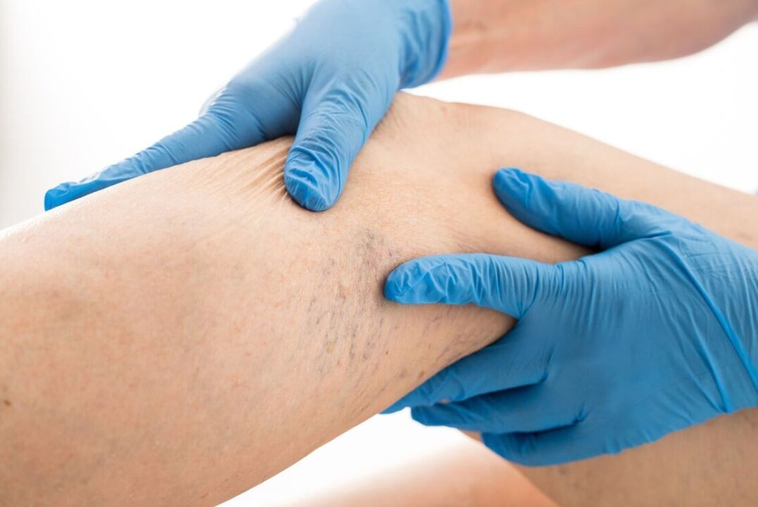 Maladie clinique de cartine variqueuse