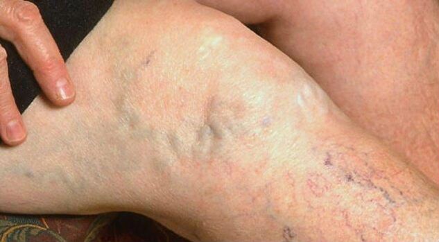 Symptômes visibles des varices sur les jambes