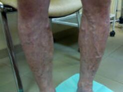 Varices sur les jambes