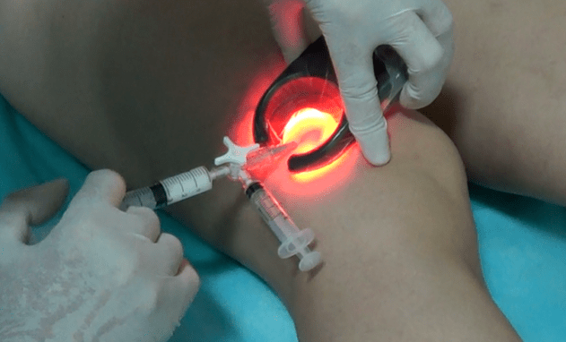 La sclérothérapie est une méthode efficace pour traiter les varices des jambes