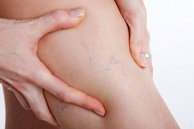 Les premières apparitions de varices sur la jambe